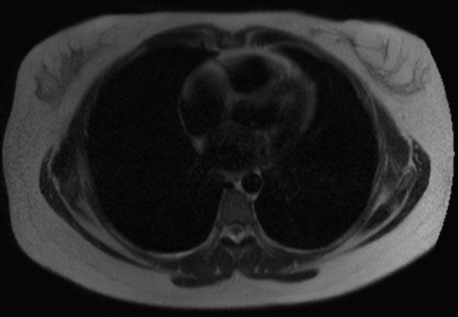 File:Normal liver MRI with Gadolinium (Radiopaedia 58913-66163 Axial T2 35).jpg