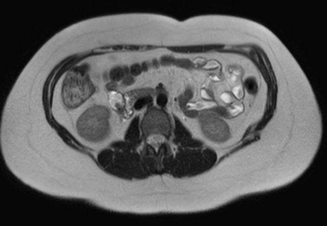 File:Normal liver MRI with Gadolinium (Radiopaedia 58913-66163 Axial T2 8).jpg