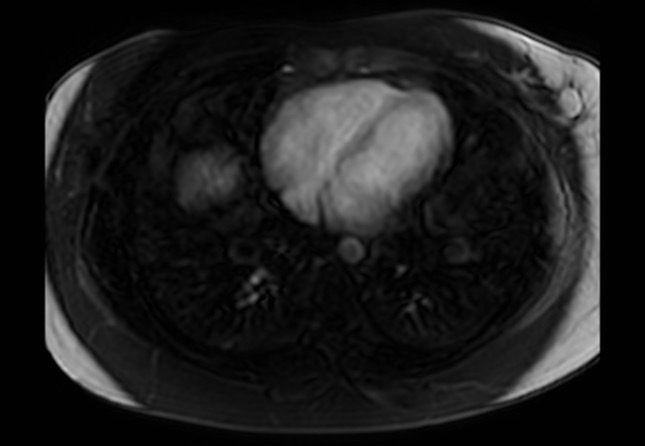 Normal liver MRI with Gadolinium (Radiopaedia 58913-66163 J 77).jpg
