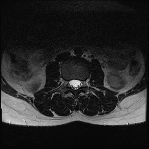 File:Normal lumbar spine MRI- 3 T (Radiopaedia 53280-59250 Axial T2 5).jpg
