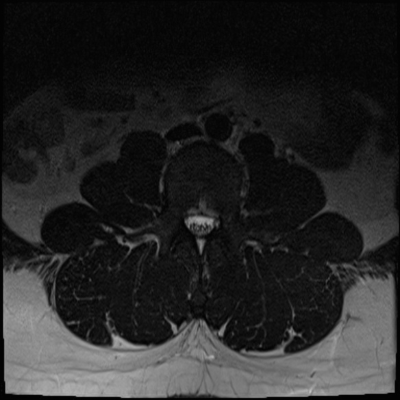 File:Normal lumbar spine MRI (Radiopaedia 47857-52609 Axial T2 2).jpg