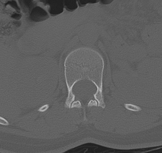 File:Normal lumbosacral CT (Radiopaedia 37923-39867 Axial bone window 29).png