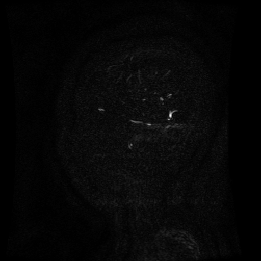 Normal noncontrast MR venography (Radiopaedia 87578-103957 A 161).jpg