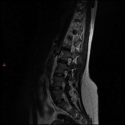 File:Normal spine MRI (Radiopaedia 77323-89408 Sagittal T2 10).jpg
