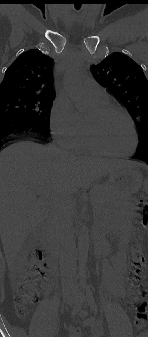 Normal thoracolumbar spine (Radiopaedia 43822-47309 Coronal bone window 17).png
