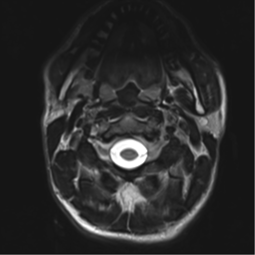 File:Normal trauma cervical spine (Radiopaedia 41017-43762 D 1).png