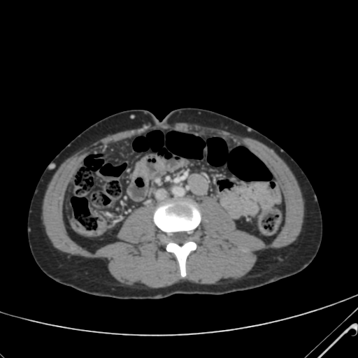 File:Nutmeg liver- Budd-Chiari syndrome (Radiopaedia 46234-50635 B 38).png