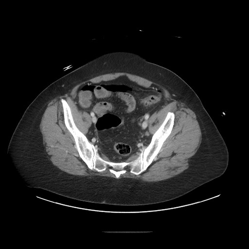 Obstructive distal colonic adenocarcinoma causing cecal perforation (Radiopaedia 86830-102989 A 159).jpg