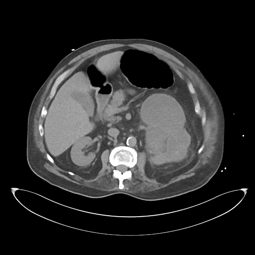 File:Obstructive pyelonephritis (Radiopaedia 46411-50844 Axial non-contrast 31).png