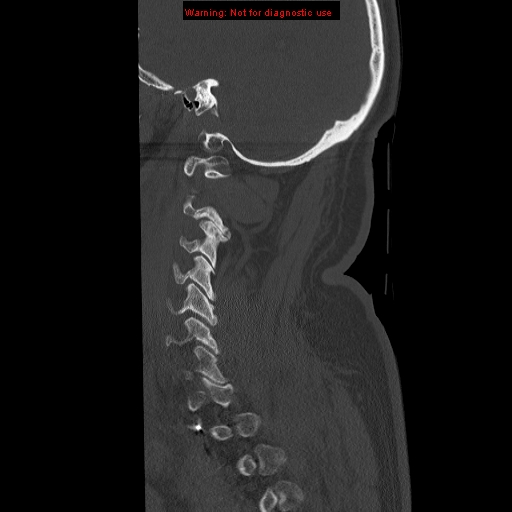 File:Occipital condyle fracture (Radiopaedia 18366-18208 Sagittal bone window 6).jpg