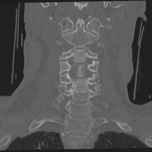 File:Occipital condyle fracture (Radiopaedia 33467-34517 Coronal bone window 29).png