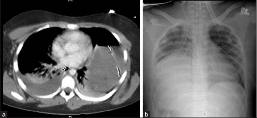 Bilateral blunt diaphragmatic rupture a) confirmation of intrathoracic herniation indicates left hemidiaphragmatic rupture b) post operative image shows elevation of right hemidiaphragm adding suspicion of right diaphragmatic rupture
