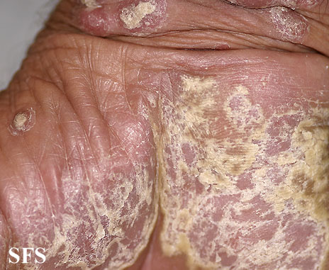 File:Psoriasis (Dermatology Atlas 34).jpg