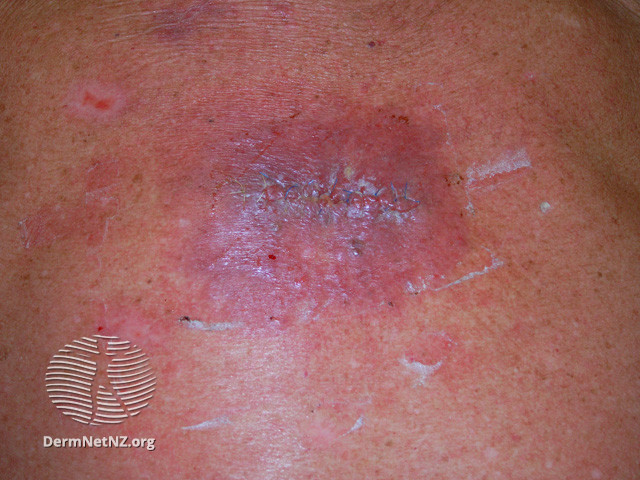 File:Wound infection (DermNet NZ bacterial-wound-infection3).jpg