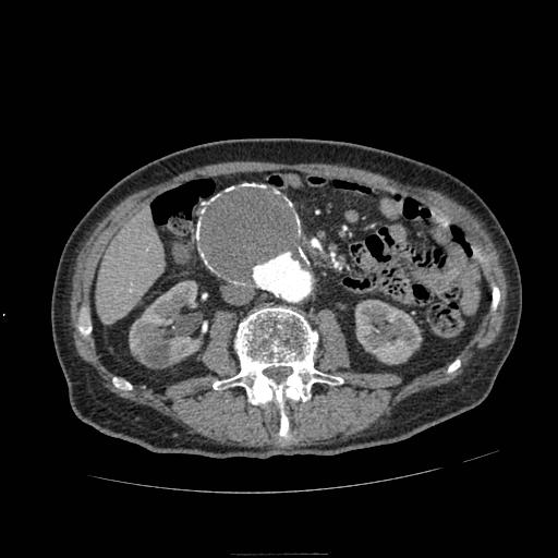 Abdominal aortic aneurysm (Radiopaedia 13341-13340 Axial C+ arterial phase 94).jpg