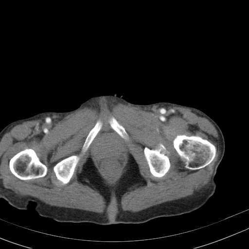 File:Abdominal aortic aneurysm (Radiopaedia 20827-20742 Axial C+ arterial phase 42).jpg
