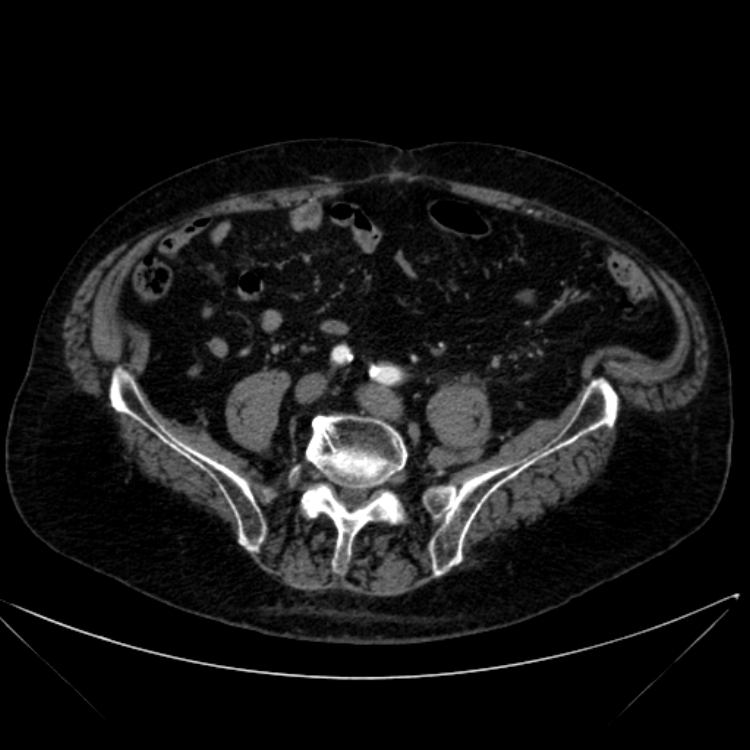 Abdominal aortic aneurysm (Radiopaedia 25855-26001 Axial C+ arterial phase 94).jpg
