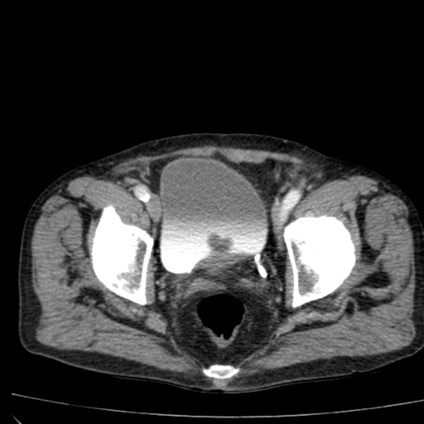 Abdominal aortic aneurysm (Radiopaedia 29248-29660 Axial C+ arterial phase 82).jpg