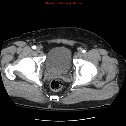 Abdominal aortic aneurysm (Radiopaedia 8190-9038 Axial C+ arterial phase 79).jpg