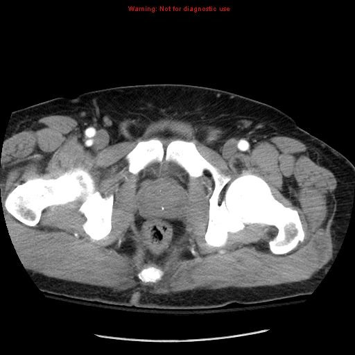 Abdominal aortic aneurysm (Radiopaedia 8190-9038 Axial C+ arterial phase 83).jpg