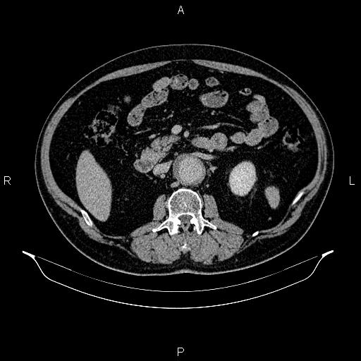 Abdominal aortic aneurysm (Radiopaedia 83094-97462 Axial renal excretory phase 45).jpg