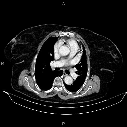 File:Abdominal aortic aneurysm (Radiopaedia 85063-100606 Axial C+ portal venous phase 17).jpg