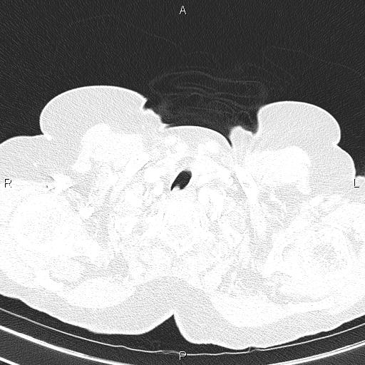 Abdominal aortic aneurysm (Radiopaedia 85063-100606 Axial lung window 9).jpg