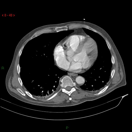 File:Abdominal aortic aneurysm rupture with aortocaval fistula (Radiopaedia 14897-14841 Axial C+ arterial phase 48).jpg