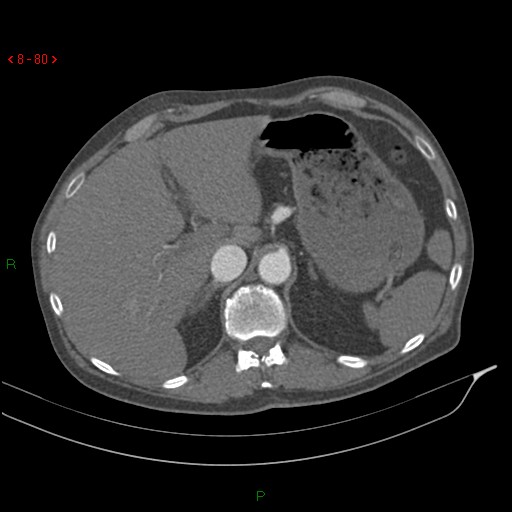 File:Abdominal aortic aneurysm rupture with aortocaval fistula (Radiopaedia 14897-14841 Axial C+ arterial phase 80).jpg