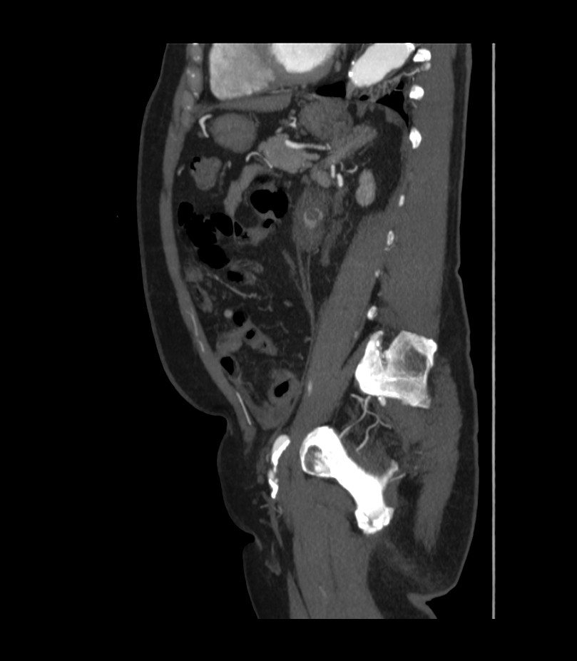 Abdominal aortic aneurysm with thrombus fissuration (Radiopaedia 46218-50618 Sagittal C+ arterial phase 39).jpg