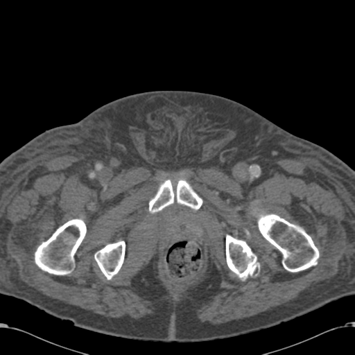 Abdominal hematoma (Radiopaedia 33614-34715 Axial C+ portal venous phase 136).png
