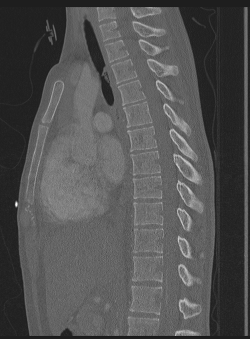 Abdominal multi-trauma - devascularised kidney and liver, spleen and pancreatic lacerations (Radiopaedia 34984-36486 Sagittal bone window 34).png