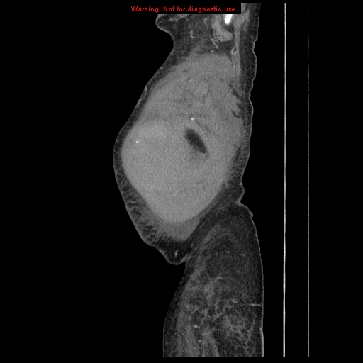 File:Abdominal wall hematoma (Radiopaedia 9427-10112 Sagittal C+ portal venous phase 104).jpg
