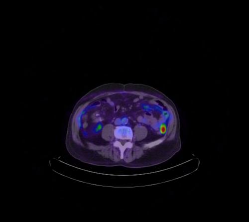 Abdominal wall metastasis from colorectal carcinoma (Radiopaedia 31016-31719 Axial 54).jpg