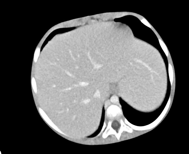 Abdominopelvic rhabdomyosarcoma (Radiopaedia 78356-90984 Axial C+ portal venous phase 43).jpg