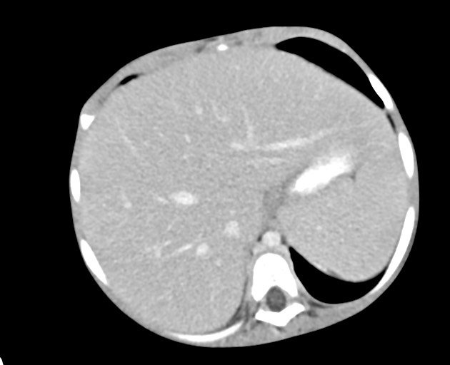 Abdominopelvic rhabdomyosarcoma (Radiopaedia 78356-90984 Axial C+ portal venous phase 46).jpg