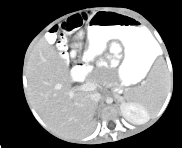 Abdominopelvic rhabdomyosarcoma (Radiopaedia 78356-90984 Axial C+ portal venous phase 57).jpg