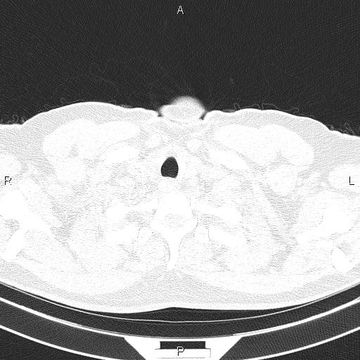 File:Aberrant right subclavian artery (Radiopaedia 87093-103354 Axial lung window 5).jpg