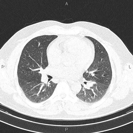 File:Aberrant right subclavian artery (Radiopaedia 87093-103354 Axial lung window 59).jpg