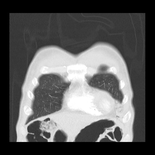 Accessory left horizontal fissure with lingular pneumonia (Radiopaedia 53763-59843 Coronal lung window 8).jpg