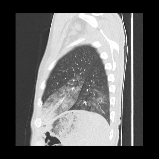 Accessory left horizontal fissure with lingular pneumonia (Radiopaedia 53763-59843 Sagittal lung window 57).jpg