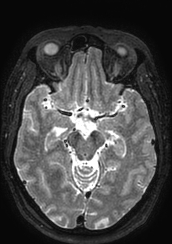 Accessory middle cerebral artery (Radiopaedia 73114-83828 Axial T2 109).jpg