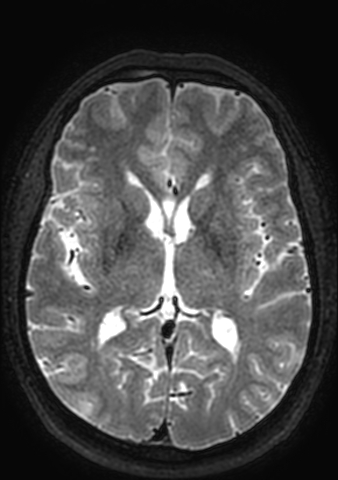 File:Accessory middle cerebral artery (Radiopaedia 73114-83828 Axial T2 64).jpg