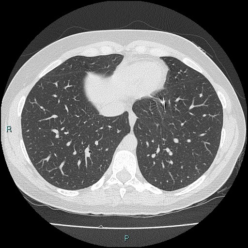File:Accidental foreign body aspiration (seamstress needle) (Radiopaedia 77740-89983 Axial lung window 49).jpg