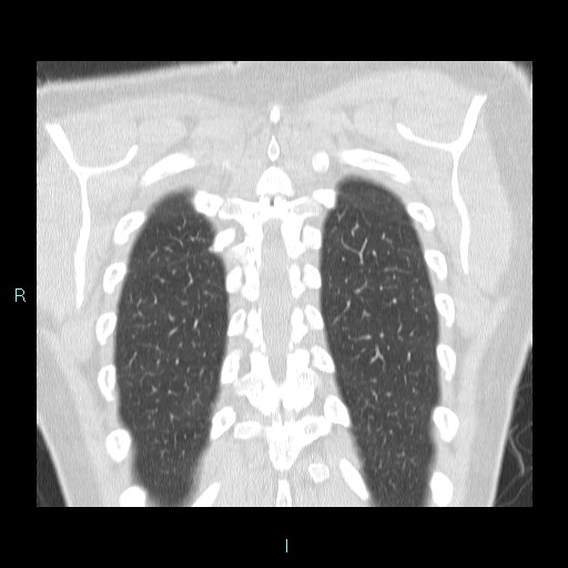 File:Accidental foreign body aspiration (seamstress needle) (Radiopaedia 77740-89983 Coronal lung window 6).jpg