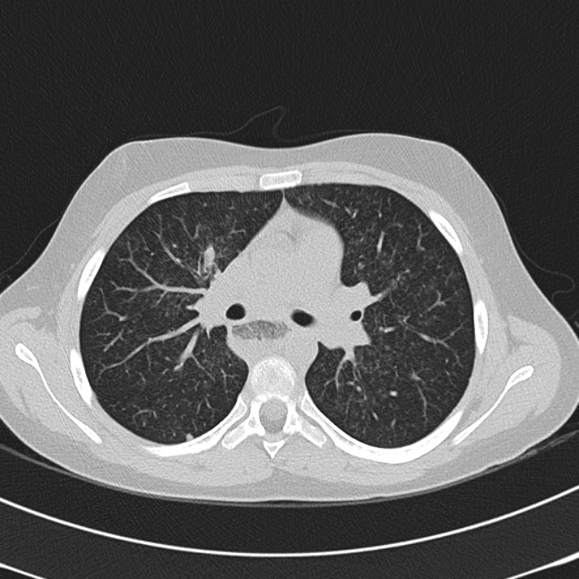 Achalasia (Radiopaedia 14946-14878 Axial lung window 30).jpg