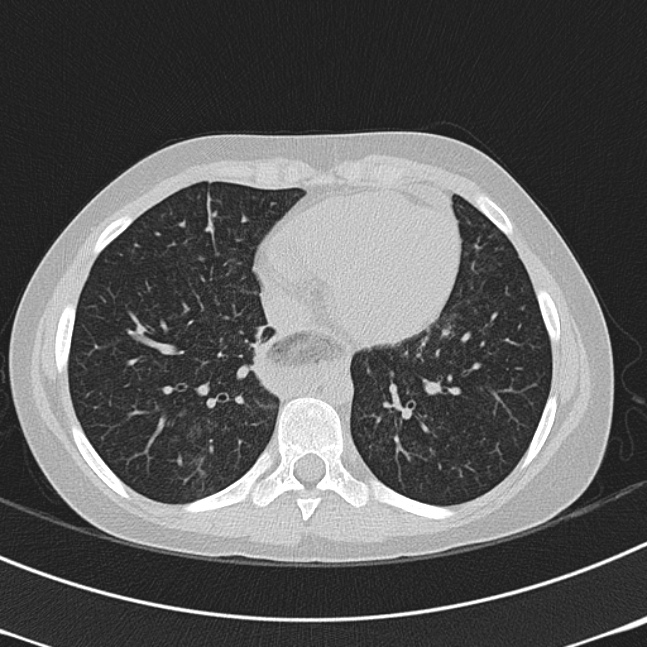 Achalasia (Radiopaedia 14946-14878 Axial lung window 54).jpg