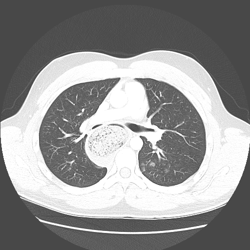 Achalasia (Radiopaedia 52507-58417 Axial lung window 27).jpg