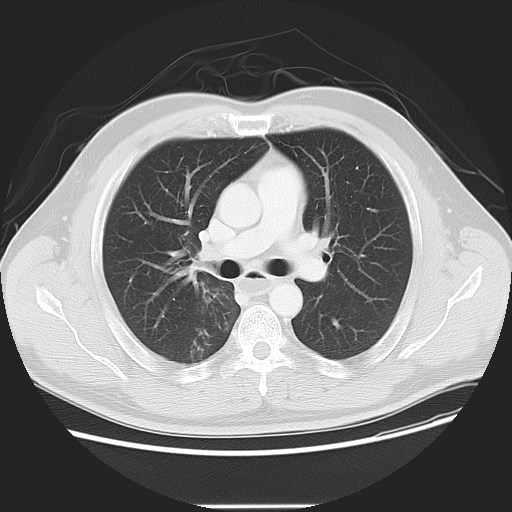 Achalasia (Radiopaedia 8831-9629 Axial lung window 28).jpg