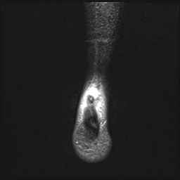 File:Achilles tendon tear (Radiopaedia 77615-89819 Coronal STIR 25).jpg
